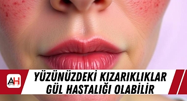 Yüzünüzdeki Kızarıklıklar Gül Hastalığı Olabilir