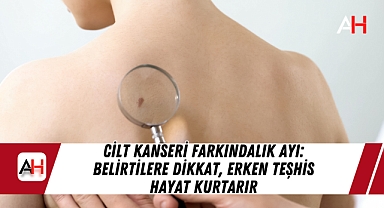 Cilt Kanseri Farkındalık Ayı: Belirtilere Dikkat, Erken Teşhis Hayat Kurtarır